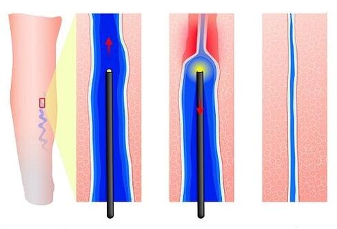 Coagulare laser