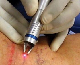 Cum se realizează tratamentul cu laser al varicelor
