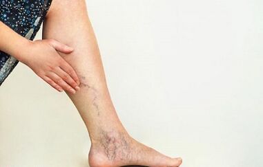 Cum să tratezi varicele extremităților inferioare
