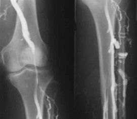 Opțiuni de diagnostic pentru vene varicoase ale extremităților