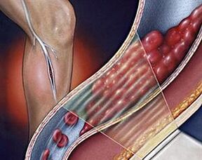 varice ale venelor profunde ale extremităților inferioare
